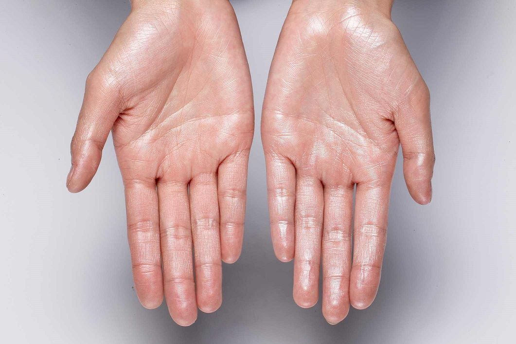 روش های درمانی عرق کردن دست