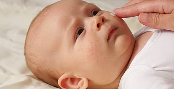 استفاده از پماد برای درمان اگزما پوست نوزاد و کودک