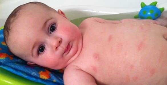 درمان اگزما پوست در نوزاد و کودک