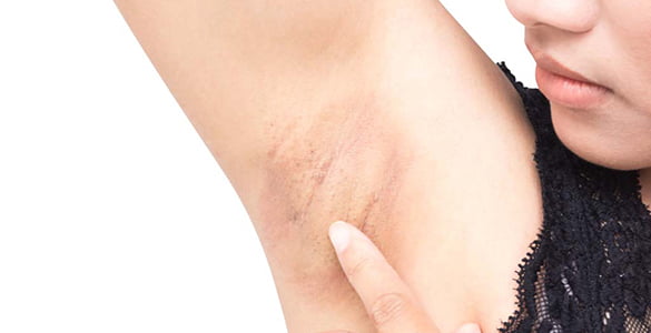 Dark underarm skin