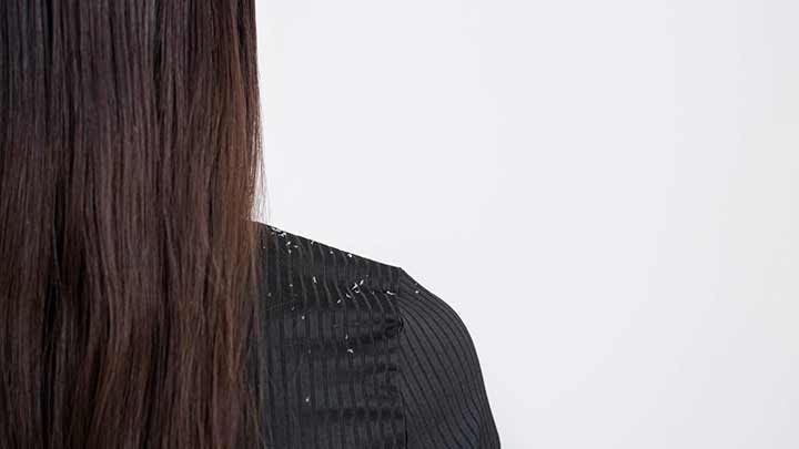 علت شوره سر و درمان آن علت شوره سر و درمان آن