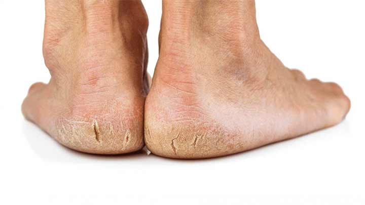 عوامل موثر بر ترک خوردن پاشنه پا عوامل موثر بر ترک خوردن پاشنه پا