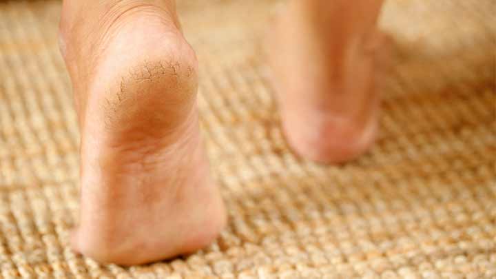 راهکارهای پیشگیری از خشکی و ترک پوست پا راهکارهای پیشگیری از خشکی و ترک پوست پا