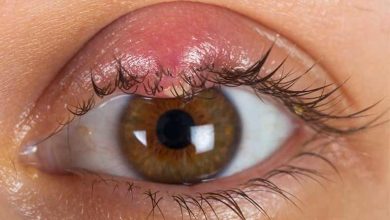گل مژه و هر آنچه که در مورد این بیماری چشمی باید بدانید