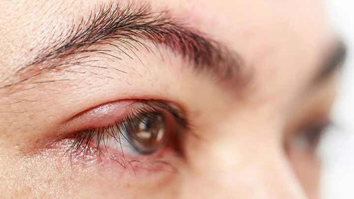 علت ایجاد گل مژه