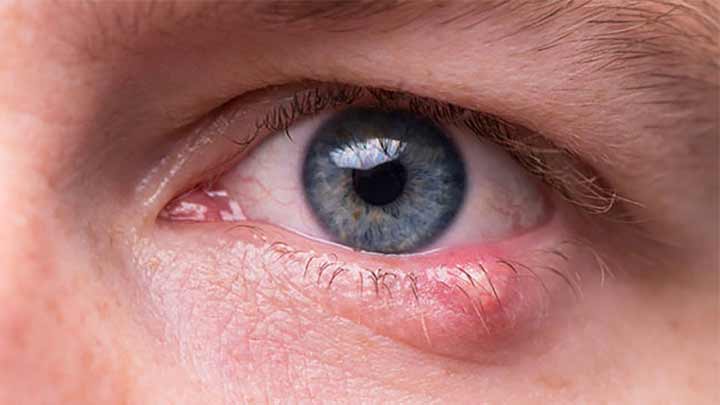 عواملی که می‌تواند خطر ابتلا به گل مژه را افزایش دهد