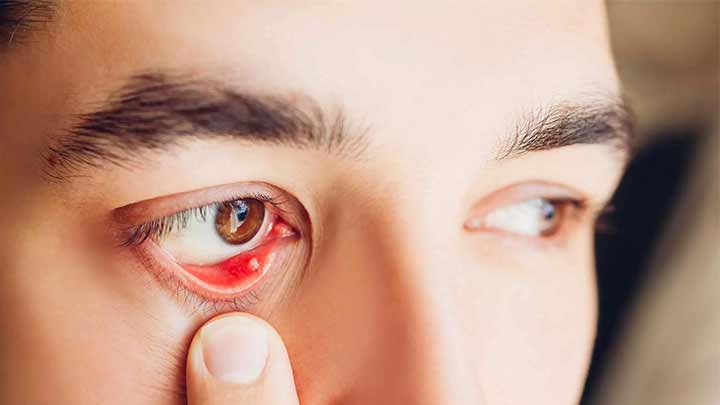 درمان ساده و سریع گل مژه با 9 راهکار خانگی