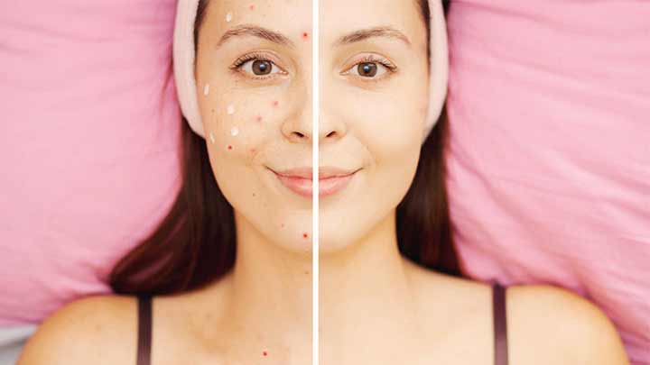 نحوه استفاده صحیح از ضد آفتاب و کاهش جوشهای صورت نحوه استفاده صحیح از ضد آفتاب و کاهش جوشهای صورت