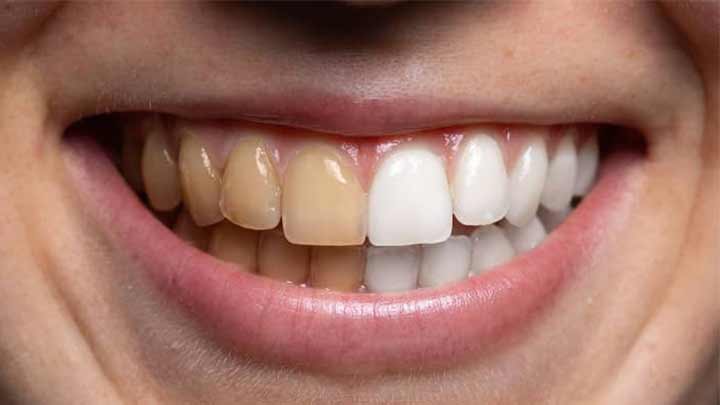 علت زردی دندان علت زردی دندان