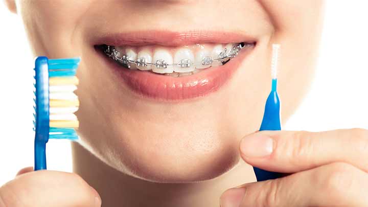 راهنمای انتخاب بهترین مسواک برای ارتودنسی