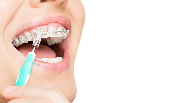 نکاتی که باید در مورد مسواک زدن دندان‌های ارتودنسی شده بدانید