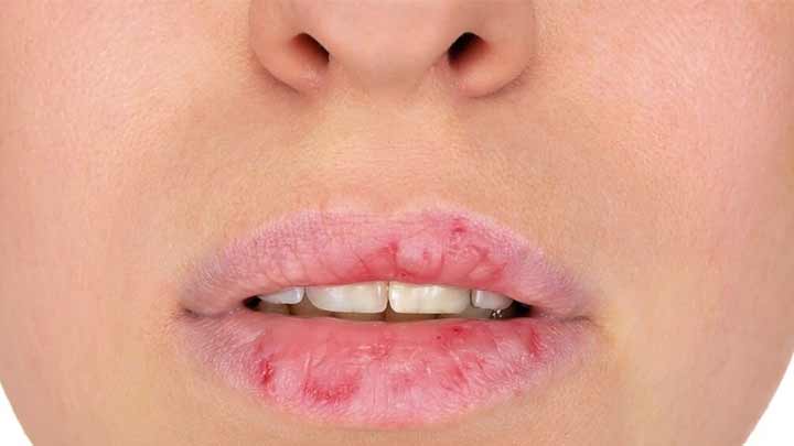 روشهای پیشگیری از لبهای ترک خورده در زمستان روشهای پیشگیری از لبهای ترک خورده در زمستان