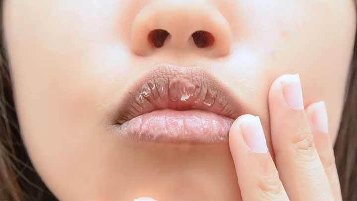 درمان خانگی ترک لب درمان خانگی ترک لب