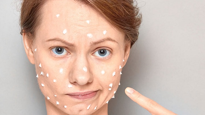 ماسک جوش شیرین و خمیر دندان برای درمان جوش ماسک جوش شیرین و خمیر دندان برای درمان جوش