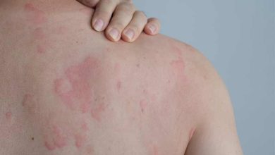 انواع آلرژی پوستی؛ علت، تشیخص و درمان آن