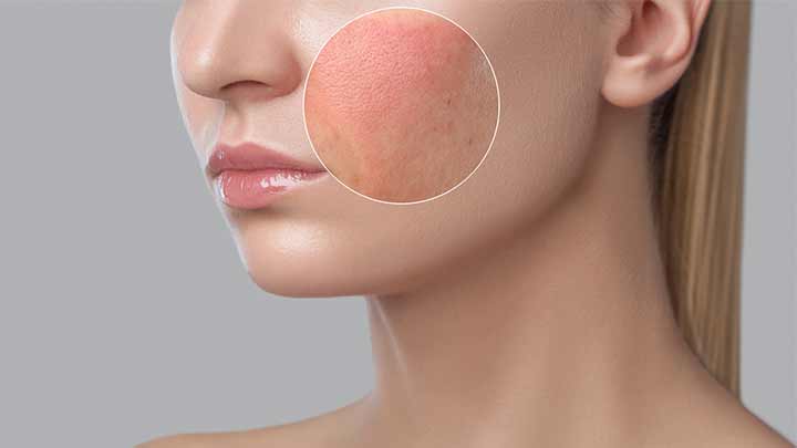 4 تا از شایعترین آلرژیهای پوستی 4 تا از شایعترین آلرژیهای پوستی