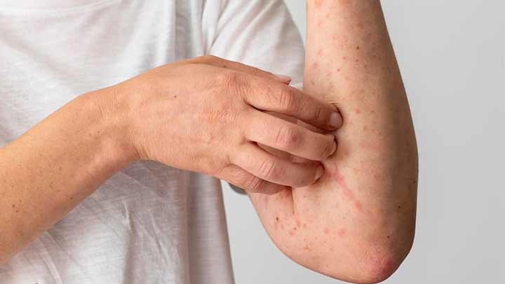 علائم آلرژی پوستی علائم آلرژی پوستی