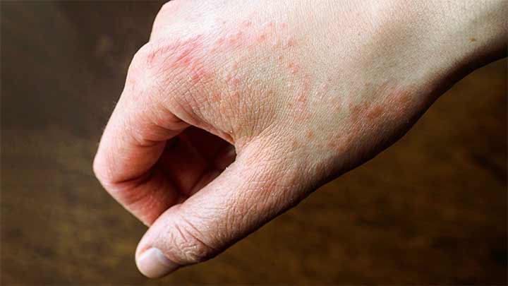 تشخیص آلرژی پوستی تشخیص آلرژی پوستی