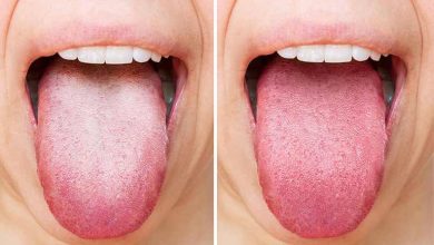 علت سفید شدن زبان چیست؟ درک علل و تفسیر نشانه‌ها