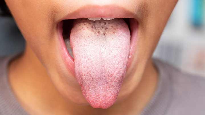 علل شایع سفید شدن زبان