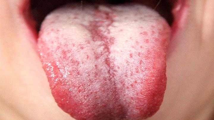 راهکار جلوگیری از سفید شدن زبان