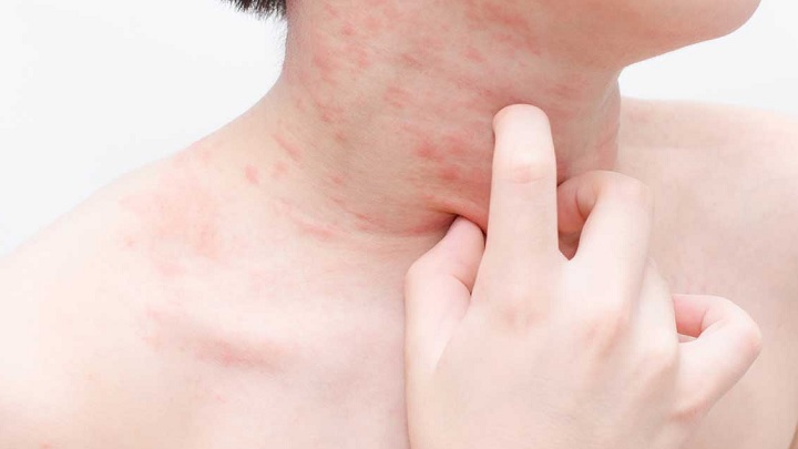 با انواع آلرژی در دوران بارداری آشنا شوید! با انواع آلرژی در دوران بارداری آشنا شوید!