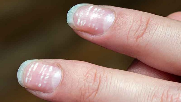 لکه های سفید روی ناخن به دلیل دلایل ارثی
