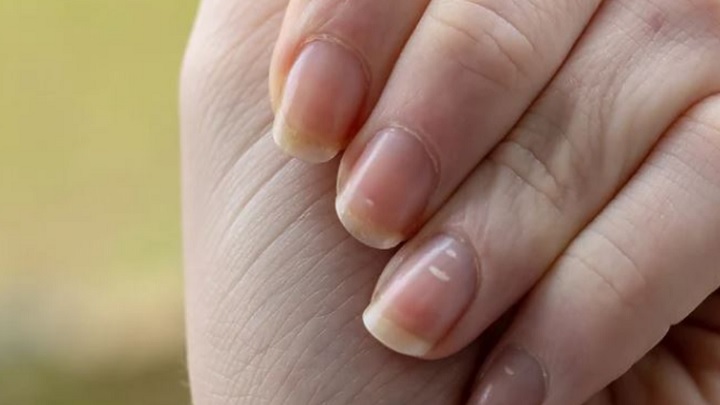لکه های سفید روی ناخن به دلیل کمبود ویتامین