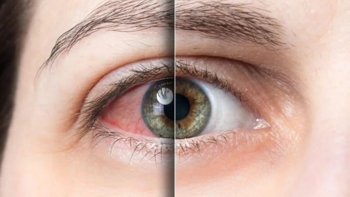 رژیم غذایی سالم از راهکارهای پیشگیری از خشکی چشم رژیم غذایی سالم از راهکارهای پیشگیری از خشکی چشم