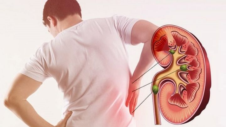 درمان دارویی سنگ کلیه