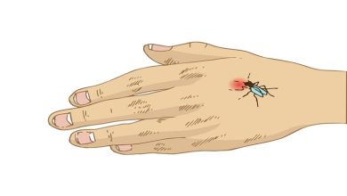 علائم انواع نیش حشرات؛ 6 راه درمان خانگی آن