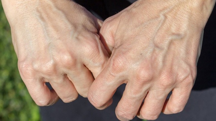 رگ‌های برجسته طبع گرم و تر