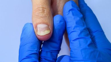 سندرم ناخن زرد چیست؟ روش های پیشگیری و درمان