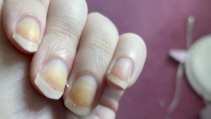 درمان سندرم ناخن زرد چگونه است؟ درمان سندرم ناخن زرد چگونه است؟