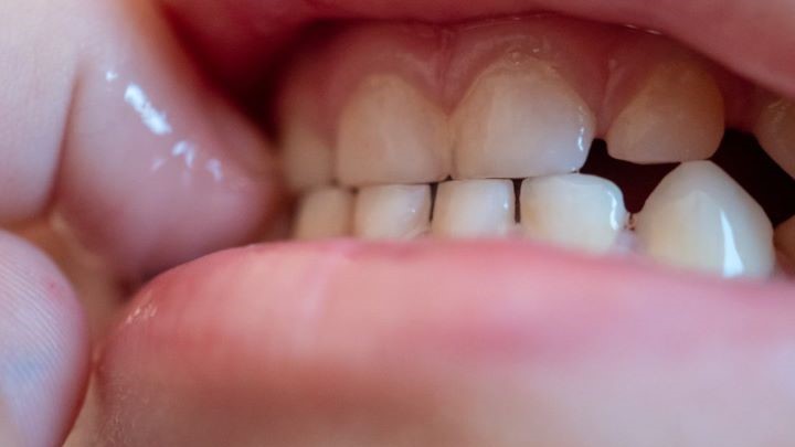 چگونه بفهمم که کودک من دندان قروچه میکند؟ چگونه بفهمم که کودک من دندان قروچه میکند؟