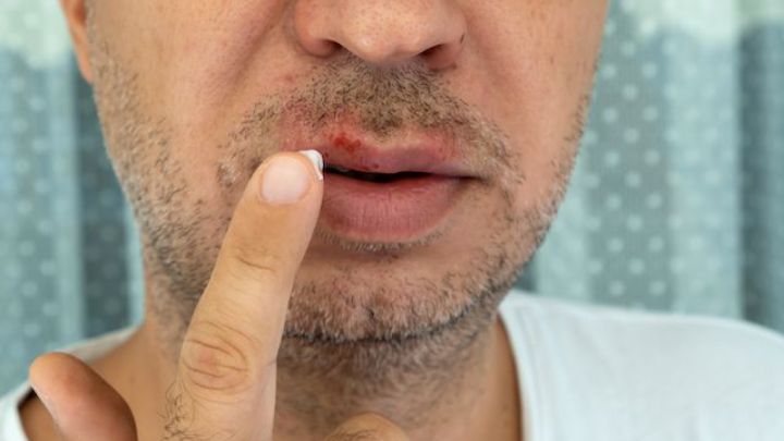 راههای درمان سریع تبخال که باید بدانید! راههای درمان سریع تبخال که باید بدانید!