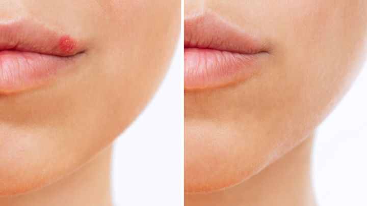 برای رهایی از تبخال این موارد را حتما رعایت کنید! برای رهایی از تبخال این موارد را حتما رعایت کنید!