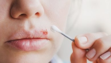 با این ترفند ساده، فوری از شر تبخال خلاص شوید!