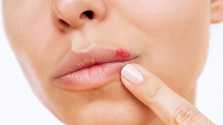 درمان فوری تبخال درمان فوری تبخال