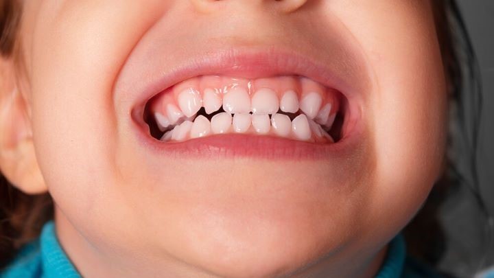 چگونه از دندان قروچه در کودکان و نوجوانان پیشگیری کنیم؟ چگونه از دندان قروچه در کودکان و نوجوانان پیشگیری کنیم؟
