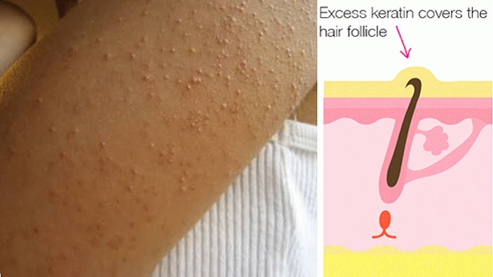 علت بیماری پوست مرغی