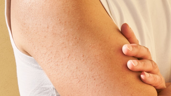 درمان پوست مرغی با استفاده از کرم آمونیوم لاکتات