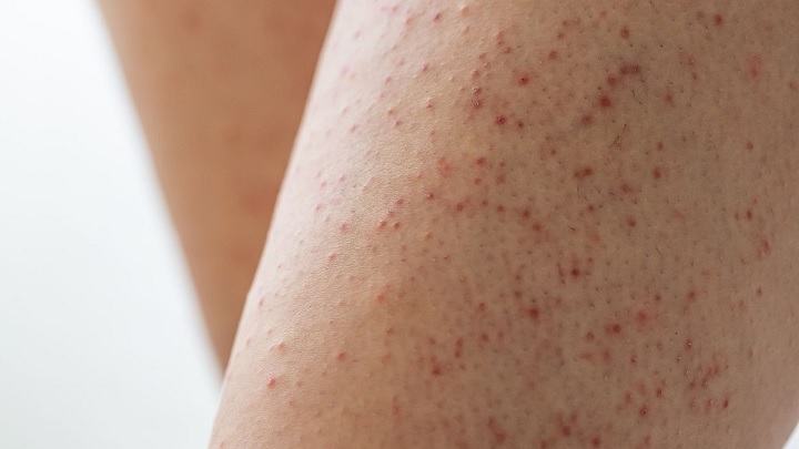 درمان پوست مرغی با استفاده از سفیدآب