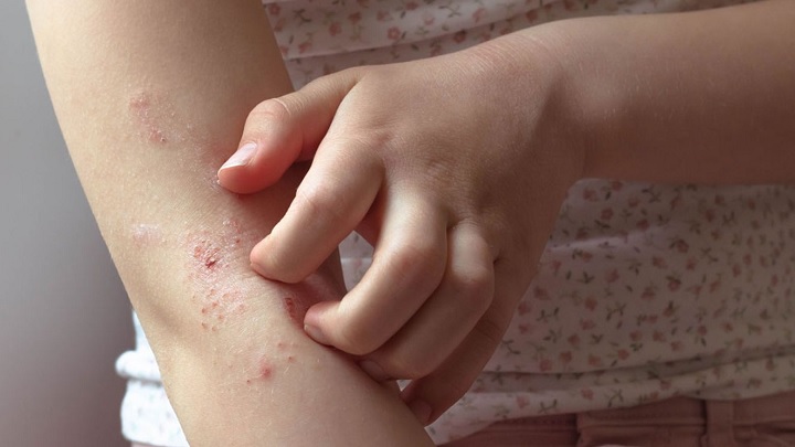 بیماریهای پوستی در کودکان در تابستان بیماریهای پوستی در کودکان در تابستان