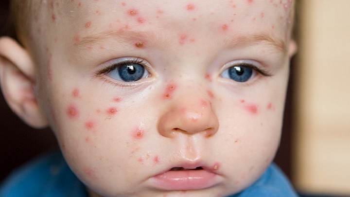 آبله مرغان در تابستان آبله مرغان در تابستان