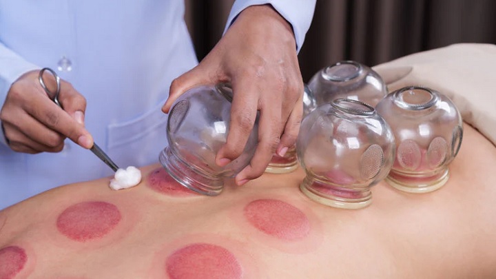 با کمک بادکش سیاتیک را درمان کنید با کمک بادکش سیاتیک را درمان کنید