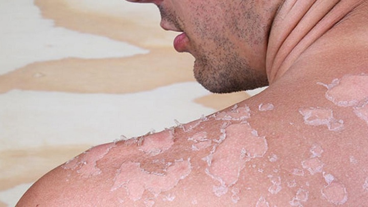 با مضرات اشعه UV برای بدن آشنا شوید