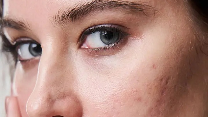 خاصیت انبه برای جای جوش صورت خاصیت انبه برای جای جوش صورت