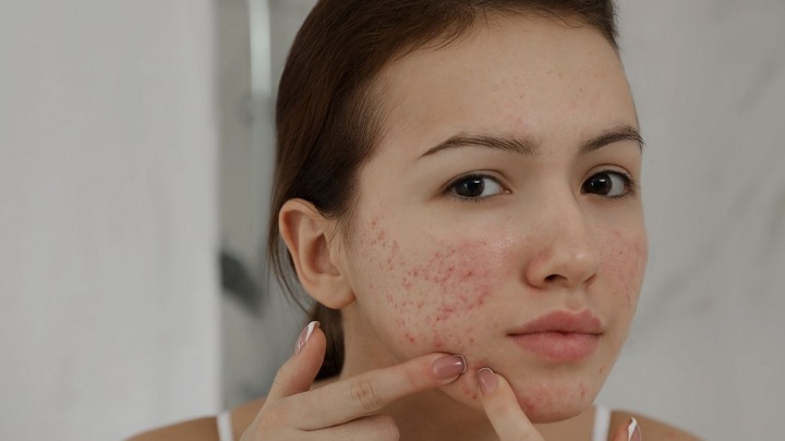 آیا خوردن انبه موجب ایجاد جوش میشود؟ آیا خوردن انبه موجب ایجاد جوش میشود؟