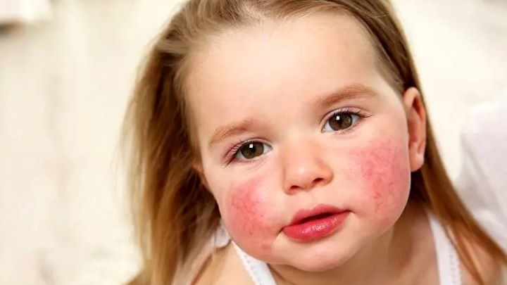 علائم واکنش آلرژیک در کودکان علائم واکنش آلرژیک در کودکان